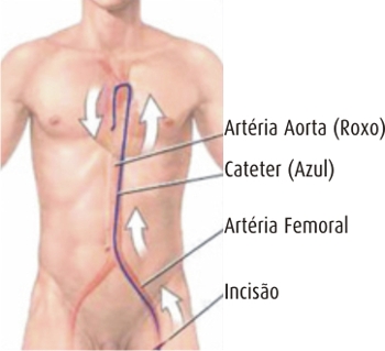 Cateterismo cardíaco: o que é e como é o procedimento?